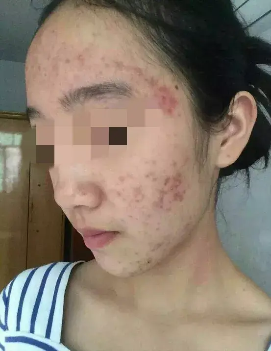 脓包型痘痘属于偏严重的痘痘,细菌微生物在毛囊里蔓延繁殖形成炎症