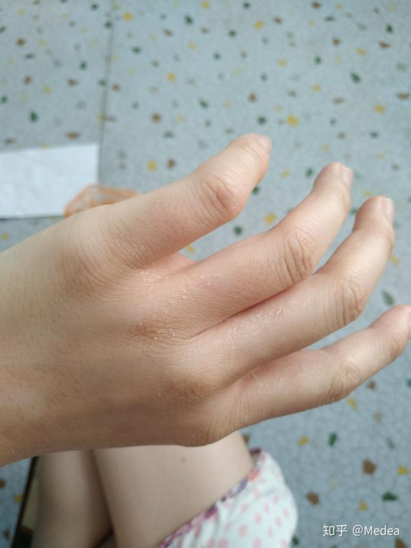 手被开水烫伤了怎么办?