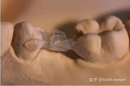 粘接桥系列粘结桥在牙半切术后的应用