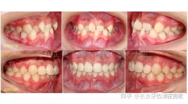 长沙牙齿矫正丨严重拥挤非拔牙牙齿矫正案例