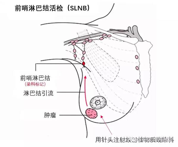 腋窝淋巴结清扫