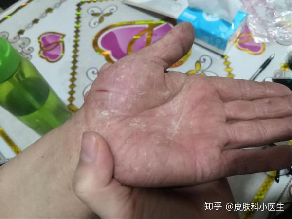 一些手湿疹的病例