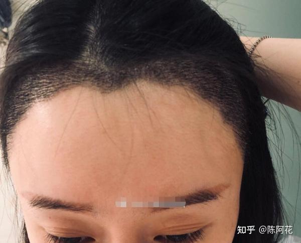 术后20天,头发看起来浓密了一些,也变长了点,但马上要进入脱落期.