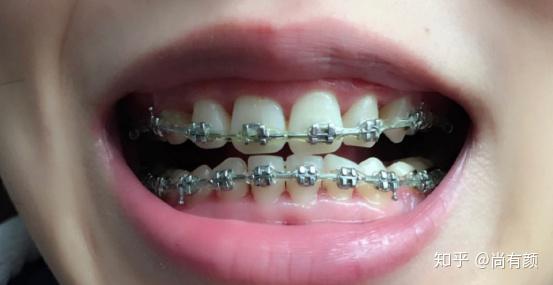 牙齿矫正是隐形牙套矫正好还是传统钢丝牙套矫正好?