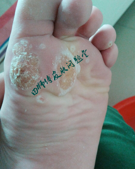 跖疣可以彻底治愈,扒一扒这些年治疗的患者病例,持续更新!望天下健康!