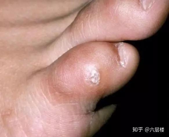 而 跖疣,是感染了人类乳头瘤病毒hpv而导致的,通常被老百姓称为瘊子