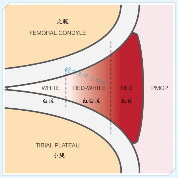 一次意外的膝关节损伤引发的一场半月板保卫战