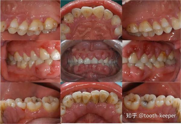 牙石(   ),全口牙龈色暗红,质韧,牙龈边缘及龈乳头明显增生肥大,呈