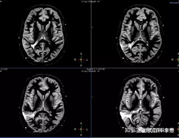 脑灰质成像( grey matter only)序列 tr=11000ms或者10500ms,大于