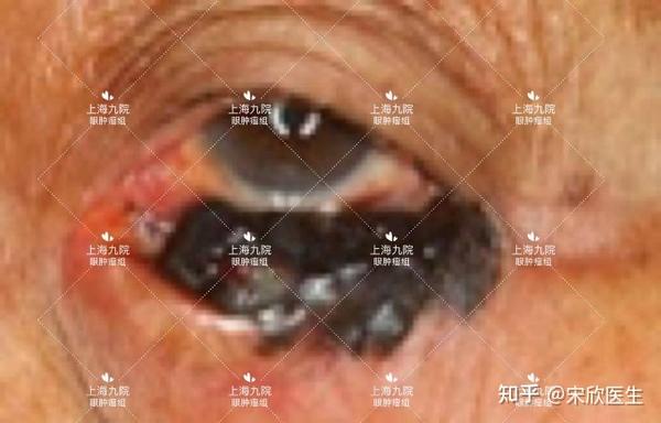 眼眶肿瘤:如泪腺肿瘤大哥,表现为眼球突出移位