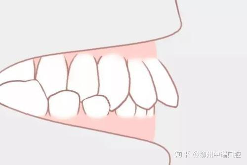 后牙反颌是什么情况