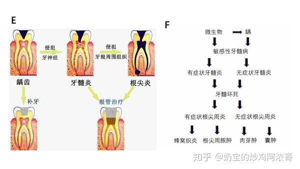 上火与牙痛