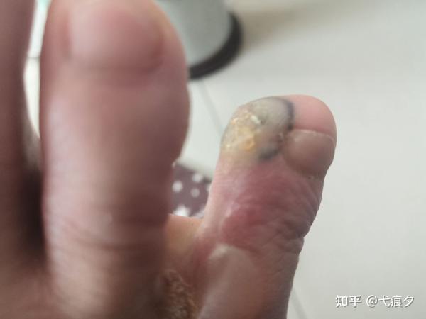 跖疣治疗历程(day2)