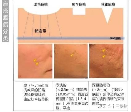 多年长痘遗留凹陷痘坑用点阵激光效果会怎样有实际治疗的伙伴能进来