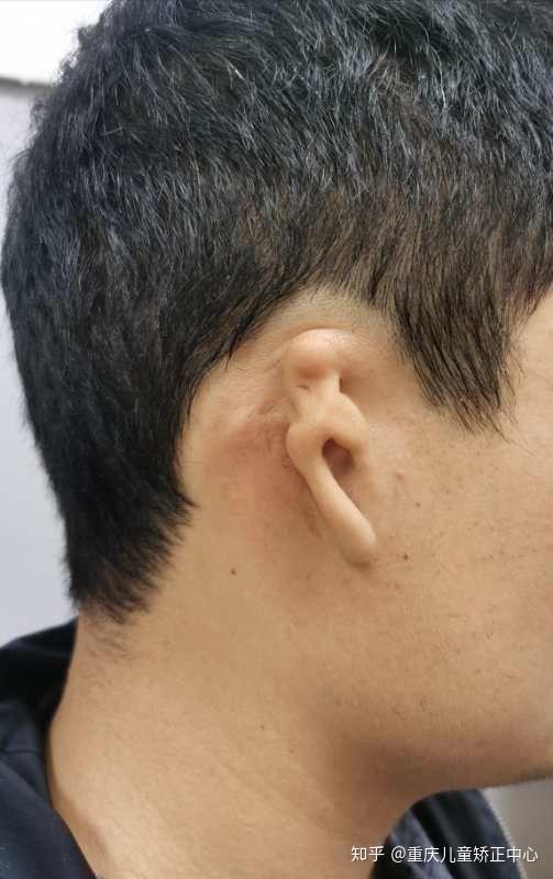 来到重庆找我"造耳",原因有二: 1,30多岁,肋骨钙化做再造耳效果不好 2