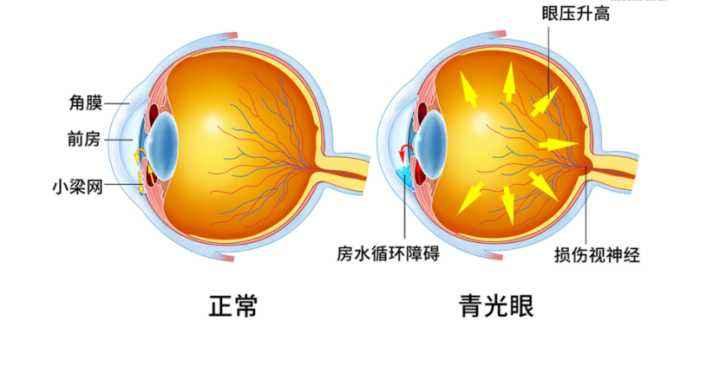 青光眼有哪些症状表现