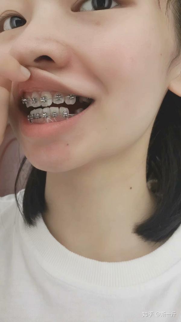女生矫正牙齿后变美是怎样的感受?
