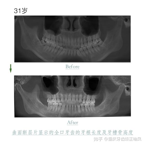 只要牙根,牙槽骨可以承受方案设计中的牙齿移动范围和移动方向,无论