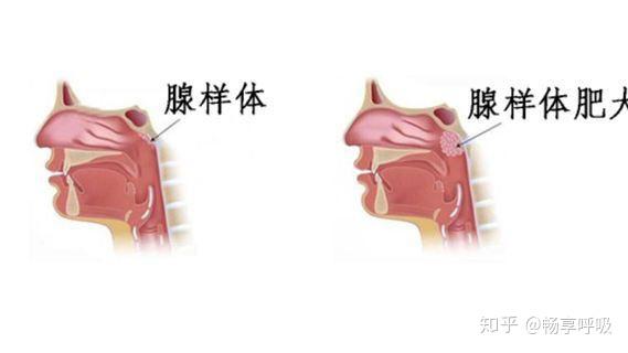 腺样体也叫做咽扁桃体,增殖体,是鼻咽部的淋巴组织,具有免疫保护作用.