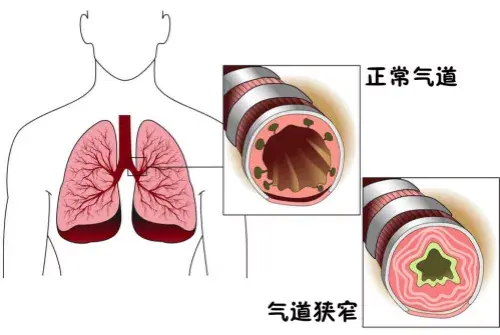 引起肺源性呼吸困难的这几类疾病也长伴随有咳嗽,咳痰甚至有发热的