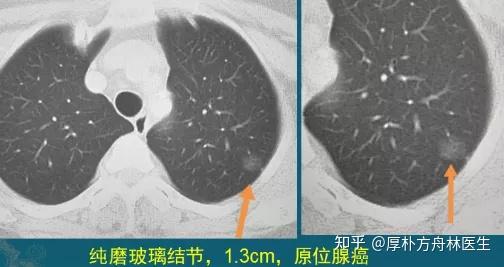 肺磨玻璃结节就是肺癌吗?