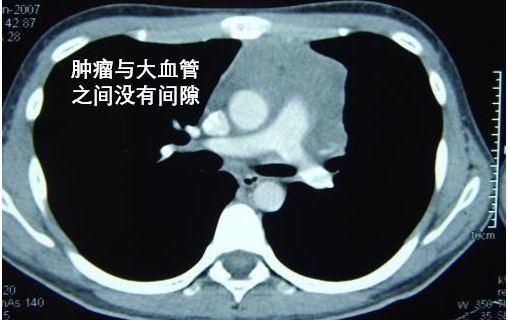 增强ct是否能判断胸腺瘤是良性还是恶性的