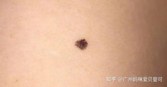 宝宝胎记不用管?不一定