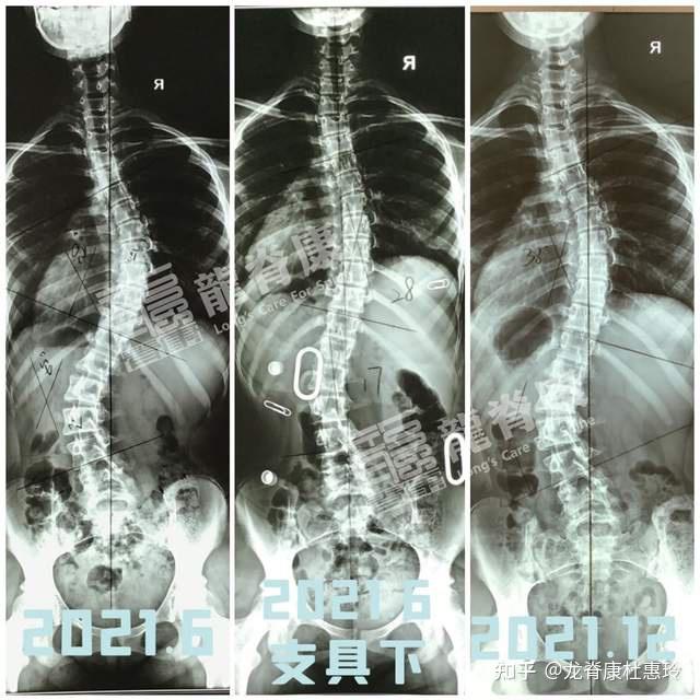 女孩脊柱侧弯50度治疗半年后减至38度成功避免手术