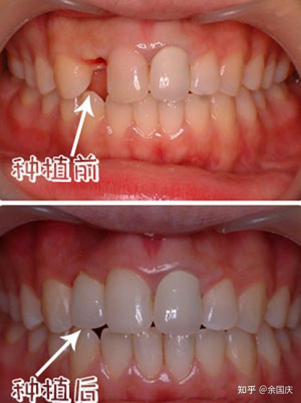 种植成功率高,牙齿咀嚼功能恢复好,使用时间长……但这比较是一项受