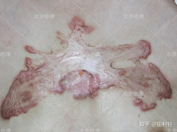瘢痕疙瘩感染的我夜不能寐现在终于能科学治疗了