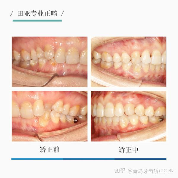 案例四:重度深覆合,单纯正畸解决骨性牙齿问题