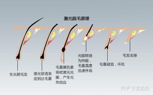 夏天要想穿的少脱毛要趁早