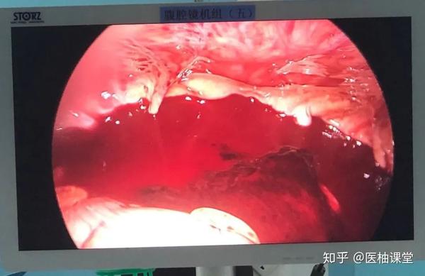 女子经期运动后黄体破裂