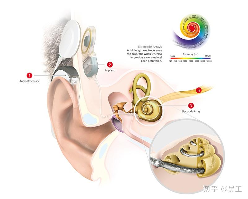 鼓阶2圈以上)全频率人工耳蜗电极示意图(可恢复70-10000hz全频率听觉)