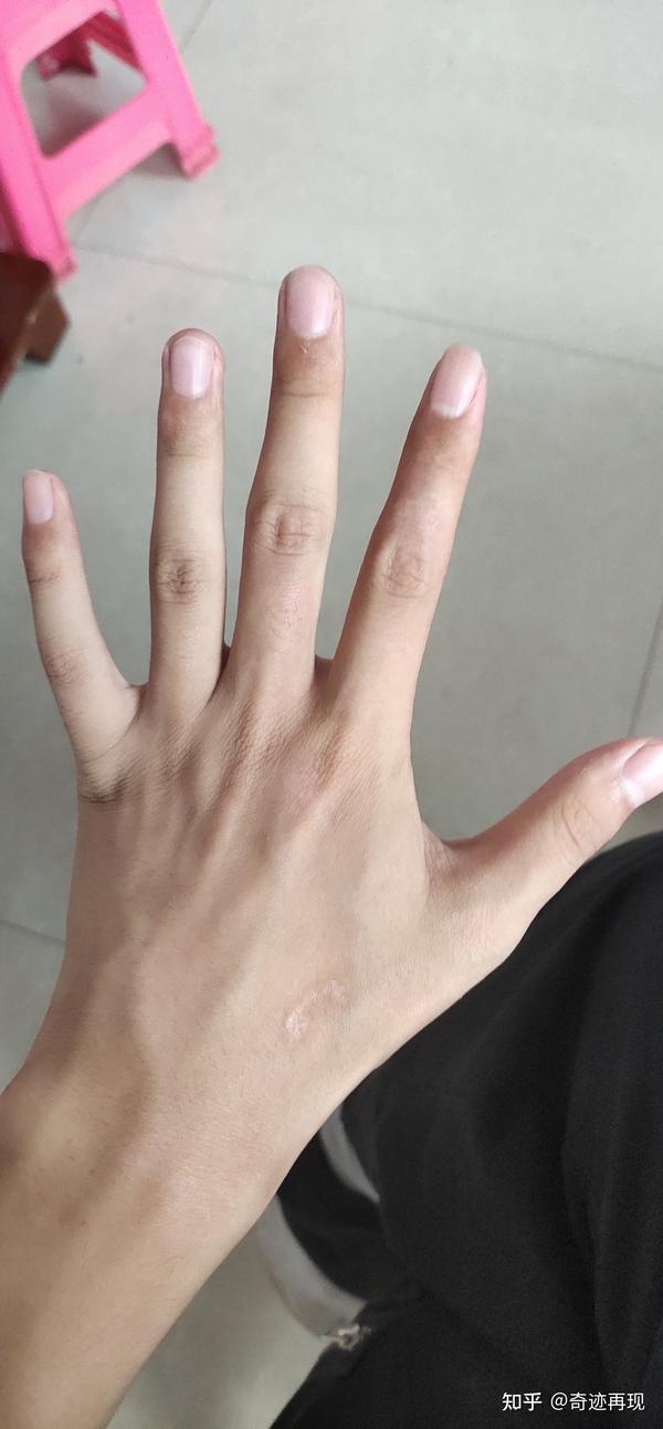 鱼粉烫伤手记录.