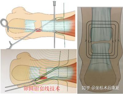 其中就包括卵圆钳带线技术box缝合方式修复跟腱,这种技术解决了经皮