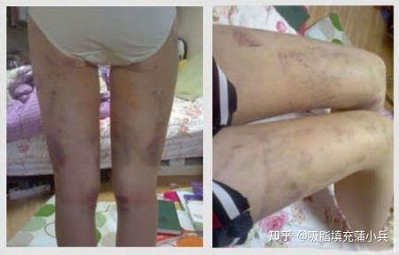 吸脂有哪些危害和后遗症