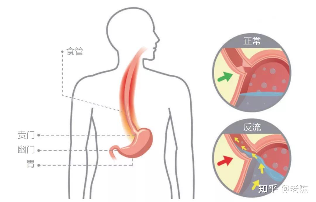 胃门关不紧导致反酸烧心