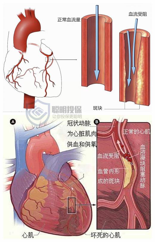 保险条款解读:急性心肌梗塞与冠状动脉介入术