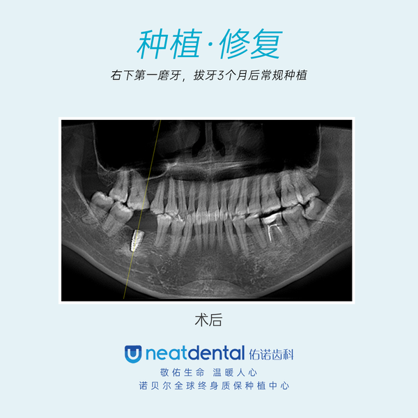 广州种植牙陈晓兵:种牙前拍摄清晰准确的x光片有多重要?