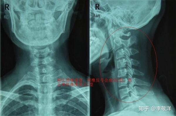 颈椎反弓(比强直更为严重的颈椎疾病)相比强直的颈椎,反弓的颈椎曲度