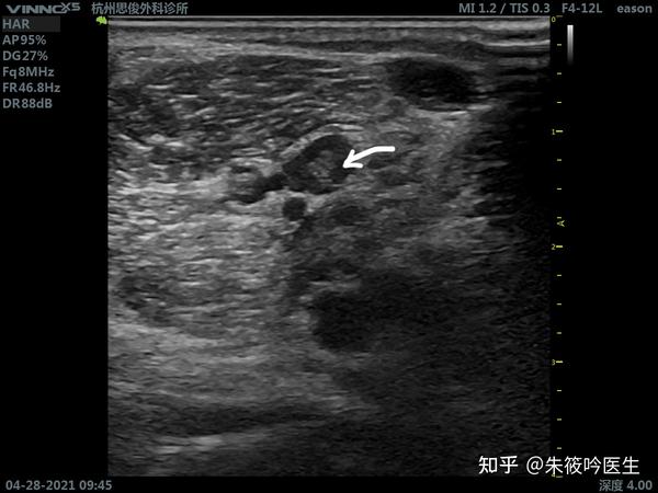 查体见右侧小腿稍粗,腓肠肌触之柔软,无挤压疼痛,双侧小腿homan征(-)