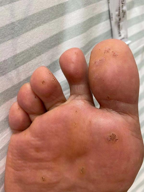 跖疣的有效疗法,试过了知乎上几乎主流的方法.