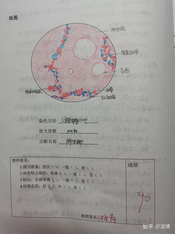 2,肺水肿