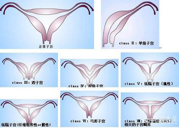 单角子宫的发病率占缪勒管发育异常的5%-20%左右,主要分为单纯的单角