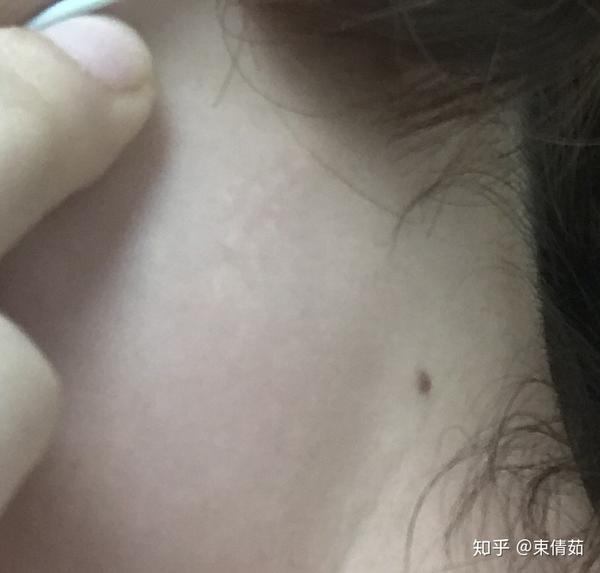 说说你的点痣经历?怎么看待?