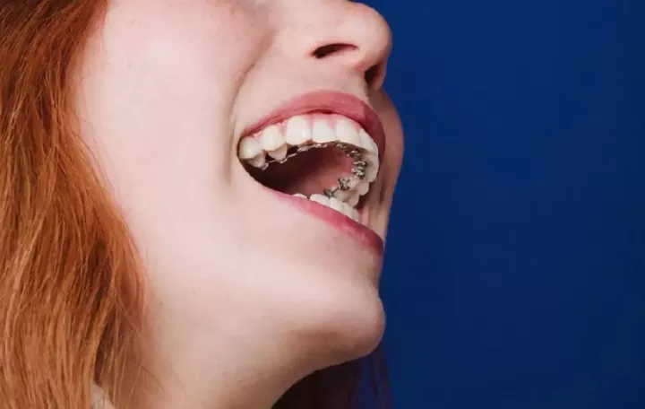 仙游牙齿矫正:舌侧隐形矫正,让你牙齿偷偷的变美!