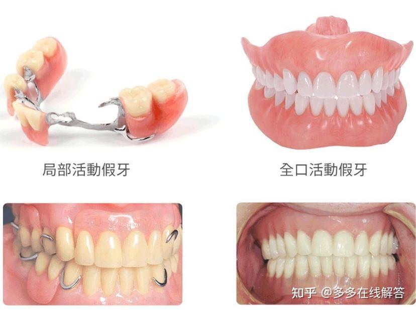 广州种植牙哪里好在广州做牙齿修复贵不贵应该怎样选择医院