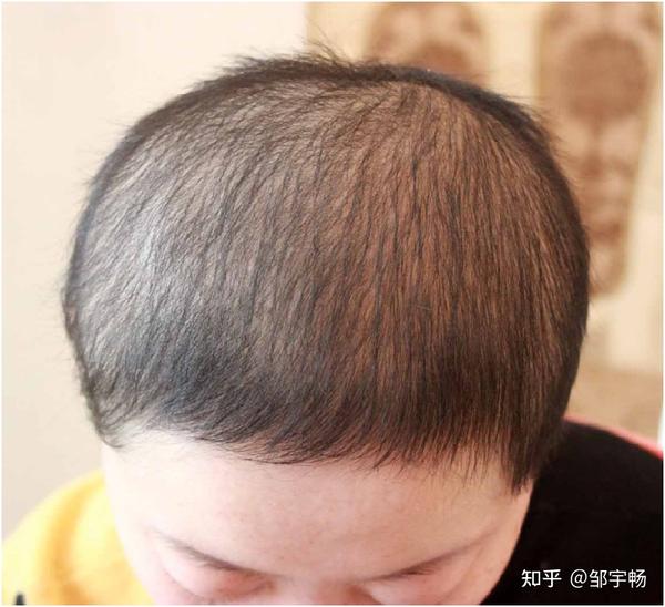 脂溢性脱发能植发吗?如果植发,几年后是否还会再次脱发?