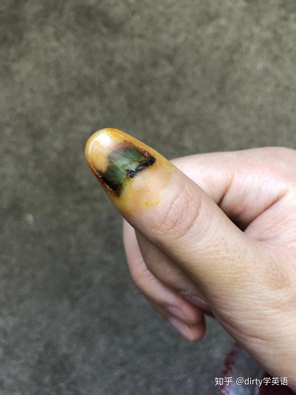 现在手指甲基本无痛感,手指肚还是偏肿,触碰会有些痛,但已经不影响我